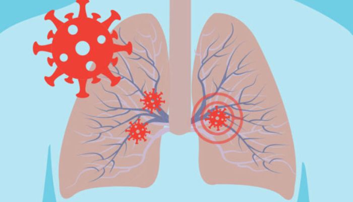 Những nguyên nhân khiến trẻ bị viêm phổi